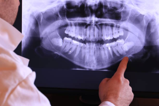 Best Emergency Wisdom Teeth Removal in Waterflow, NM